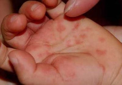 "HFMD".. فيروس مُعدٍ يصيب الأطفال