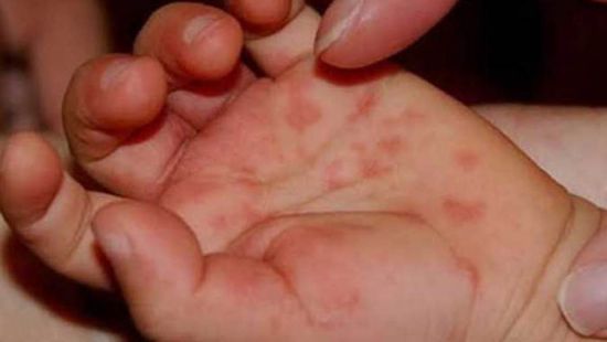 "HFMD".. فيروس مُعدٍ يصيب الأطفال
