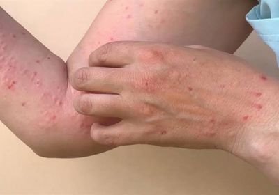 وزارة الصحة في ناميبيا تعلن عن رصد بؤرة لتفشي جدري القردة