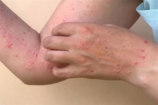 وزارة الصحة في ناميبيا تعلن عن رصد بؤرة لتفشي جدري القردة