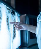 علماء يكتشفون المحرك الرئيسي لتطور سرطان الرئة في مراحله المبكرة