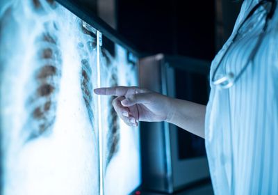 علماء يكتشفون المحرك الرئيسي لتطور سرطان الرئة في مراحله المبكرة