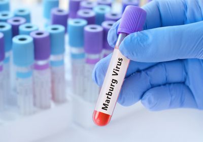 إثيوبيا تعلن تفشي وباء "ماربورغ" جنوب البلاد