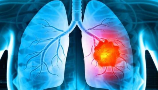 اكتشاف لقاح جديد للوقاية من سرطان الرئة