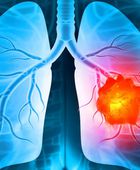 روسيا تسجل علاجًا لأكثر سرطانات الرئة خطورة