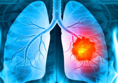 روسيا تسجل علاجًا لأكثر سرطانات الرئة خطورة