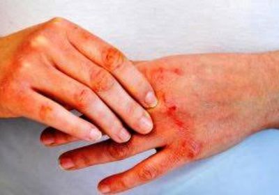 دراسة: حمل الرضع في أقمشة معالجة بمبيدات يقلل حالات الملاريا