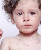 ارتفاع الإصابات بالحصبة في ولاية ساوث كارولاينا الأمريكية إلى 153