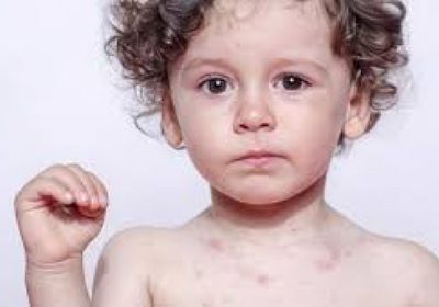 ارتفاع الإصابات بالحصبة في ولاية ساوث كارولاينا الأمريكية إلى 153