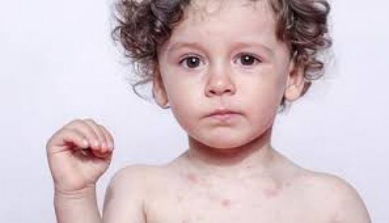 ارتفاع الإصابات بالحصبة في ولاية ساوث كارولاينا الأمريكية إلى 153