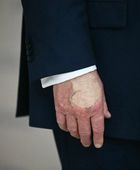 ما سبب كدمة يد ترامب؟.. مفاجأة