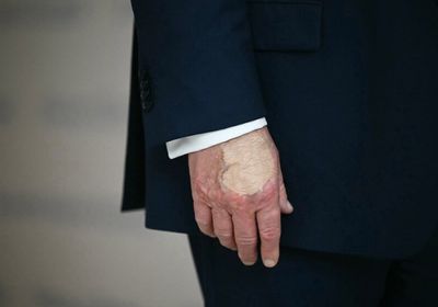 ما سبب كدمة يد ترامب؟.. مفاجأة