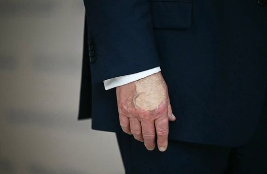 ما سبب كدمة يد ترامب؟.. مفاجأة