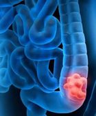 دراسة: وفيات السرطان بين الشباب تنخفض 44% باستثناء سرطان القولون والمستقيم