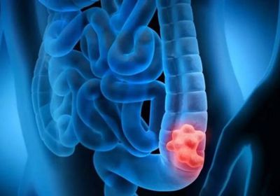 دراسة: وفيات السرطان بين الشباب تنخفض 44% باستثناء سرطان القولون والمستقيم