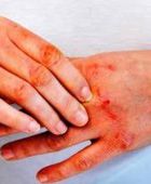 إثيوبيا تعلن انتهاء تفشي وباء ماربورج الذي أودى بحياة 9