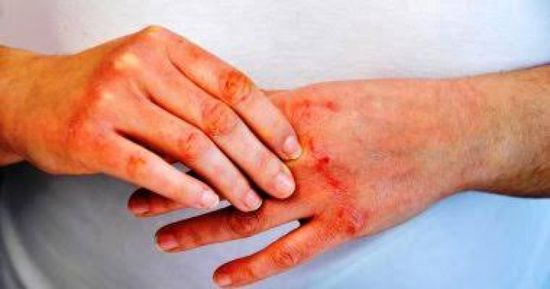 إثيوبيا تعلن انتهاء تفشي وباء ماربورج الذي أودى بحياة 9