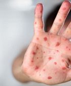 تفشي عدوى الحصبة في 14 منطقة بإسرائيل