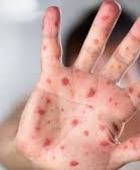 الصحة العالمية ترصد إصابتين بسلالة جديدة من جدري القرود