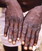 روسيا تسجل إصابتين بجدري القردة