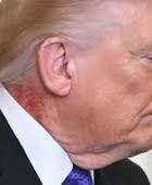 بقعة حمراء تثير التساؤلات..  طبيب البيت الأبيض يكشف سبب الطفح الجلدي على رقبة ترامب