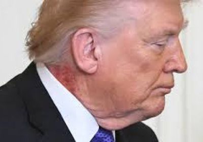 بقعة حمراء تثير التساؤلات..  طبيب البيت الأبيض يكشف سبب الطفح الجلدي على رقبة ترامب