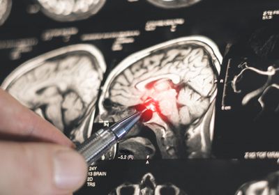 اكتشاف روسي جديد يفتح الطريق لتطوير أدوية لعلاج باركنسون