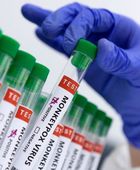 الكونغو الديموقراطية تعلن انتهاء تفشي مرض جدري القرود