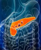 دواء أمريكي واعد يمنح الأمل لمرضى سرطان البنكرياس