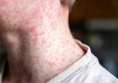 460 إصابة.. الحصبة تتوحش في ولاية بنسلفانيا الأمريكية