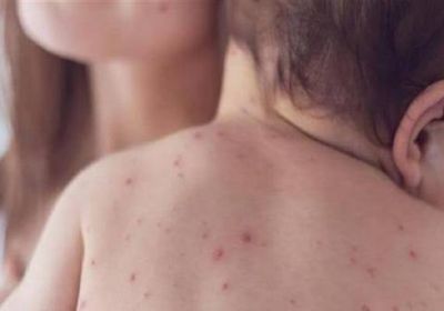 بنجلادش تواجه أسوأ موجة انتشار للحصبة بسبب تراجع التطعيم