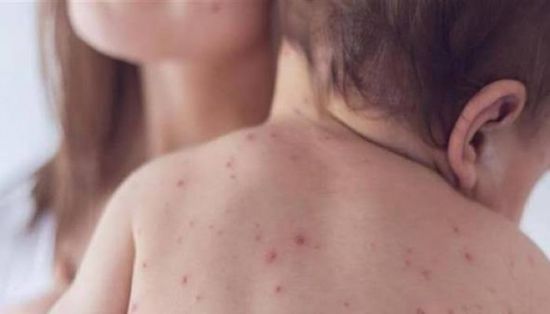 بنجلادش تواجه أسوأ موجة انتشار للحصبة بسبب تراجع التطعيم