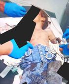 إصابة طفلة بجروح إثر انفجار بقايا مقذوف بمديرية الضالع
