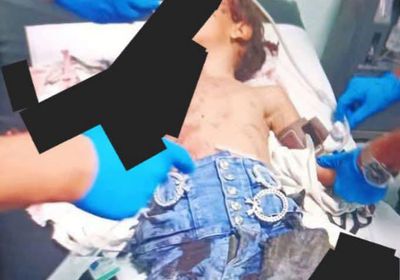 إصابة طفلة بجروح إثر انفجار بقايا مقذوف بمديرية الضالع