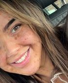 وحمات تغطي 98% من جسدها.. لورا كيلي تخوض رحلة تقبل الذات